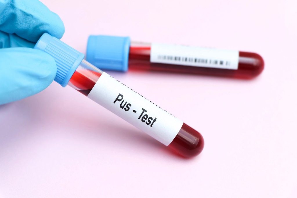 Medical sample for immediate analysis, highlighting same day STD test in Shenandoah.