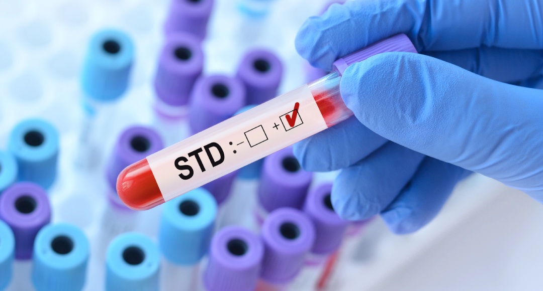 Positive STD test result in lab—affordable and accurate diagnostics available through cheap STD testing Houston.