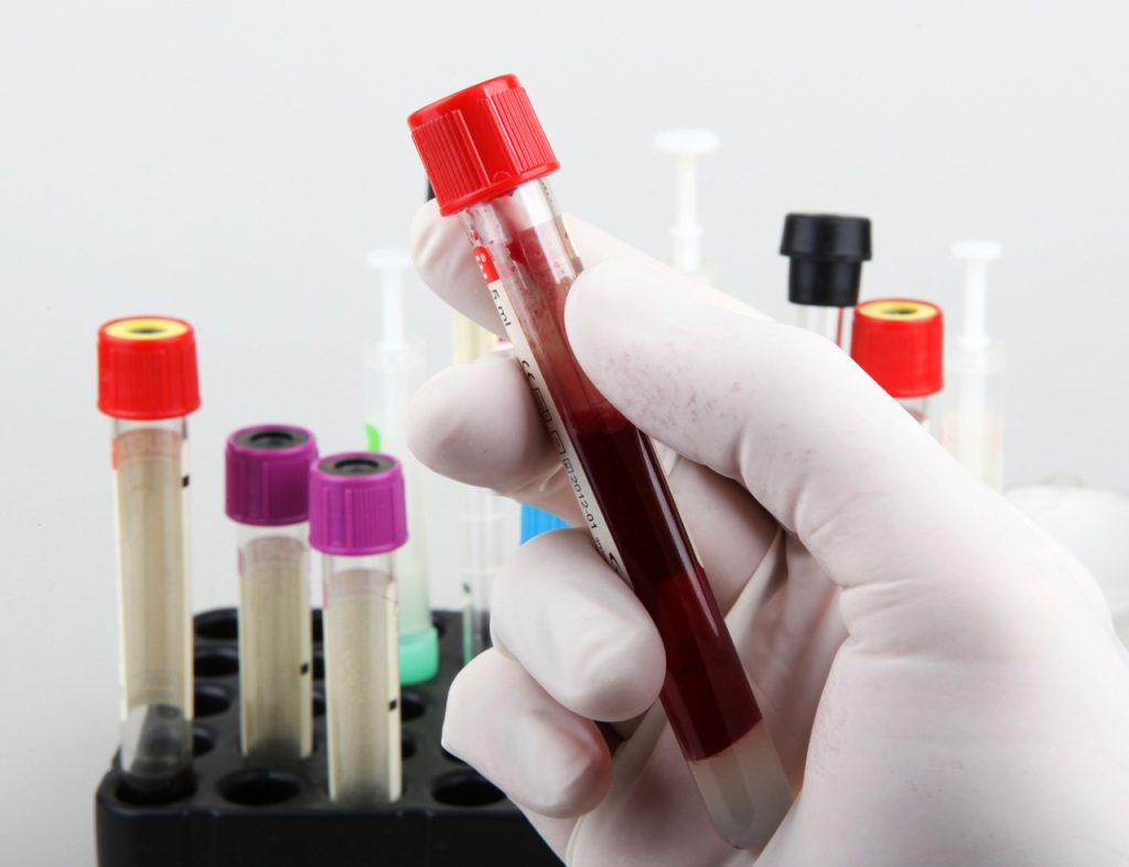 Close-up of a blood sample vial, processed for affordable STI testing Houston services.