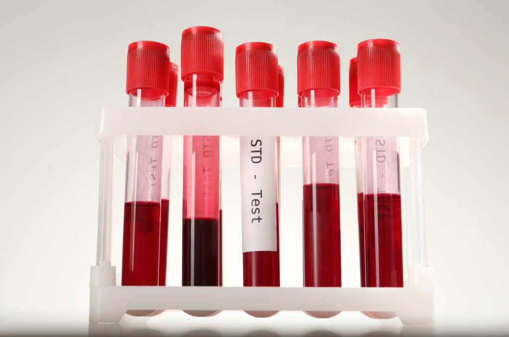 Blood samples in test tubes for STD testing in a lab rack, illustrating cheap STD testing in Houston.