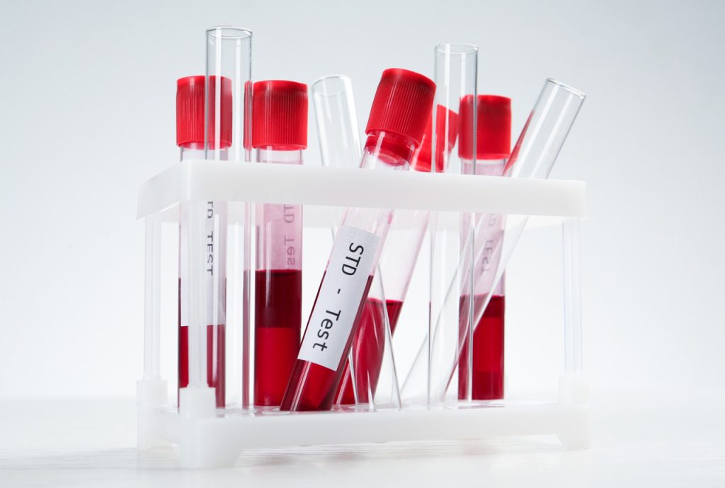Blood sample vials on a lab report for biochemistry results and professional std testing houston medical services.