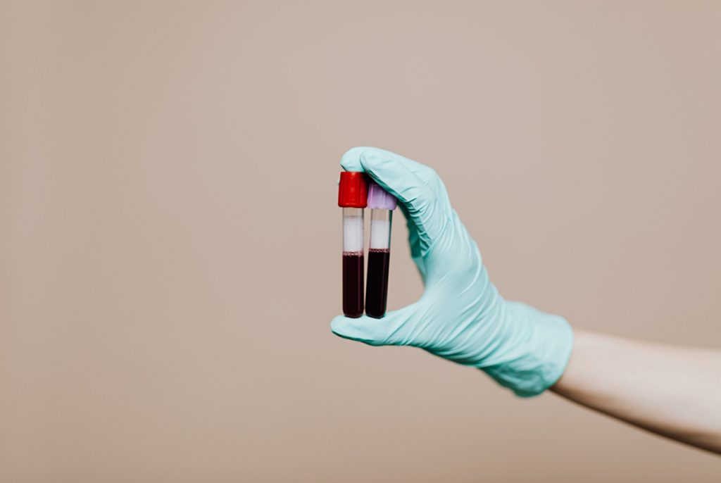 Comparative blood sample vials held by a specialist during a routine diagnostic for STD treatment Houston clinic.
