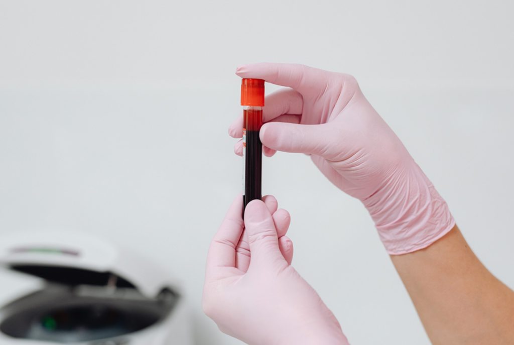 Expert lab technician holding a vial for blood analysis during an essential STD treatment Houston medical screening.