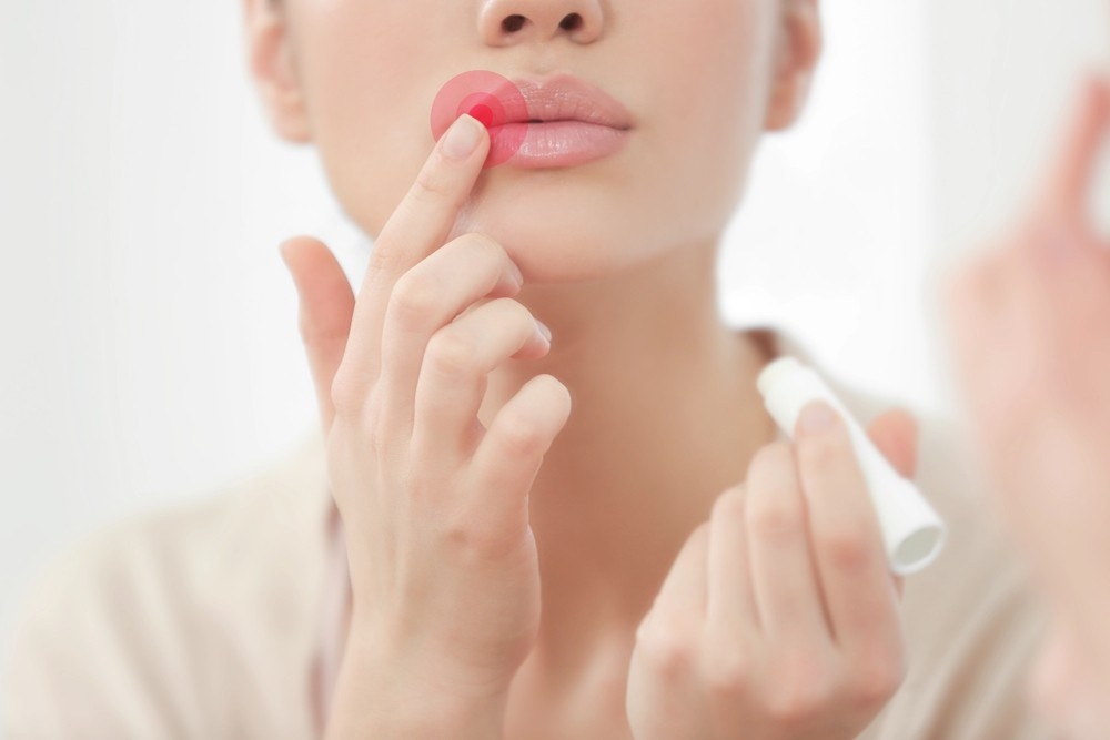 Woman points to red lip sore (cold sore). If you have symptoms like this, get fast and accurate herpes testing Houston at our clinic.